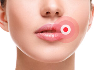 BOUTON DE FIEVRE